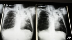 Raios-X de um doente com tuberculose num hospital do estado americano da Florida. 